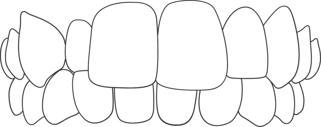 crossbite, a Common Orthodontic Problem