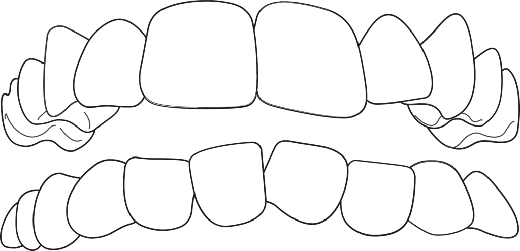 crowded teeth, a Common Orthodontic Problem