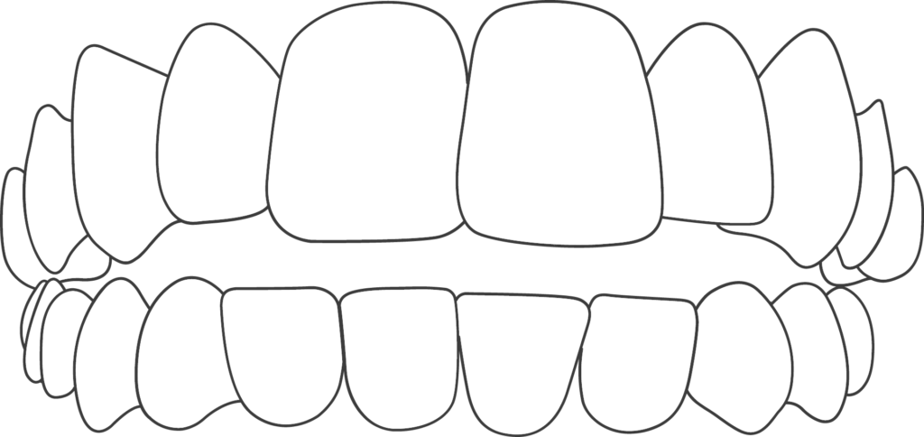 openbite, a Common Orthodontic Problem