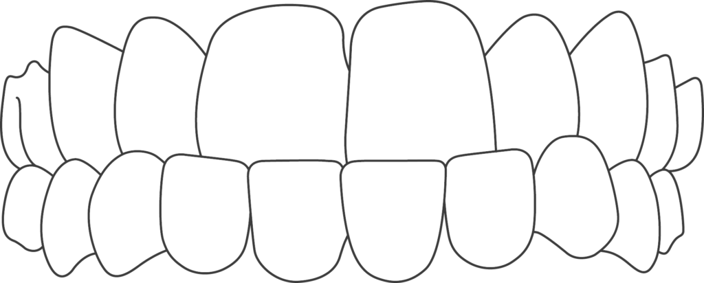 underbite, a Common Orthodontic Problem