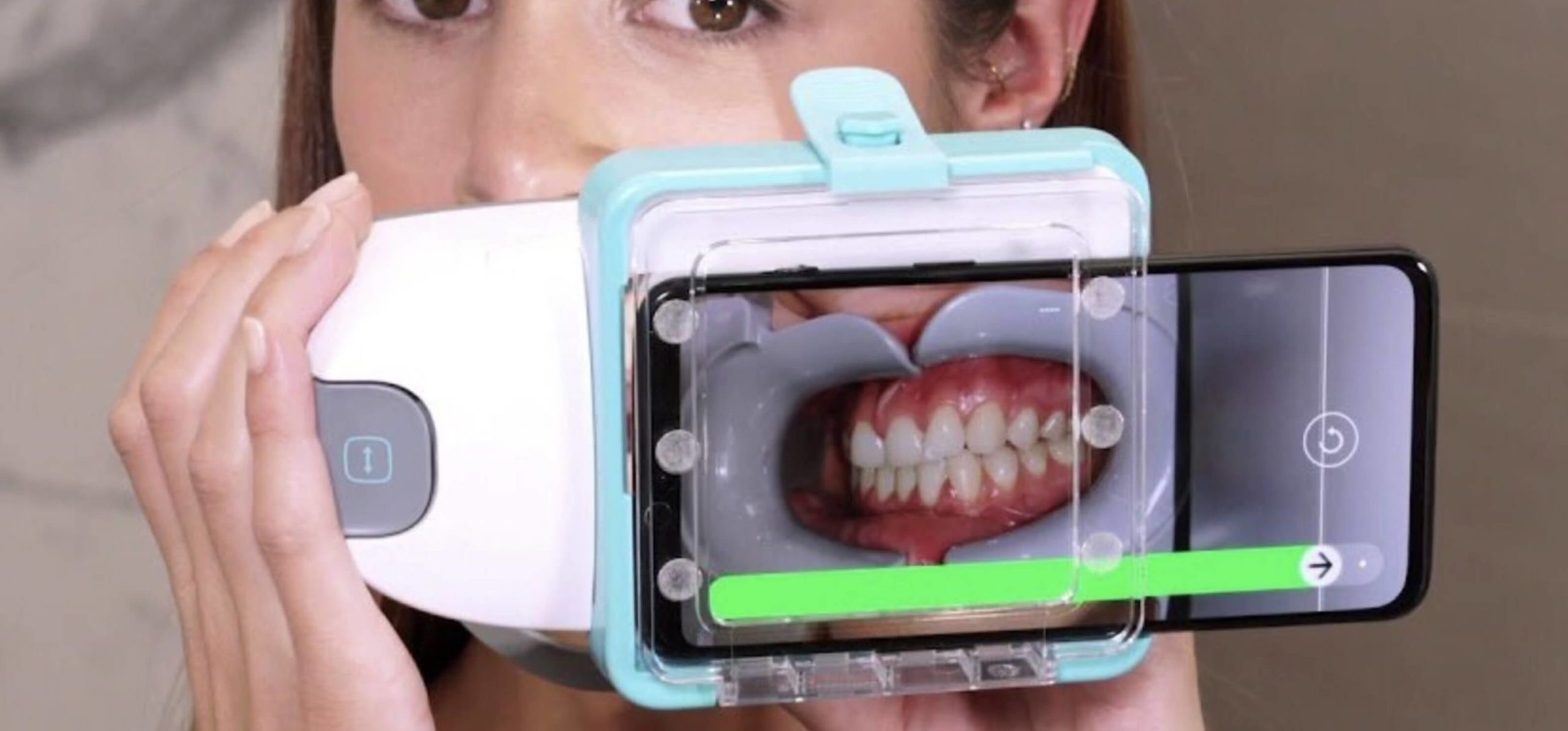 clear aligners patient using the dental monitoring app