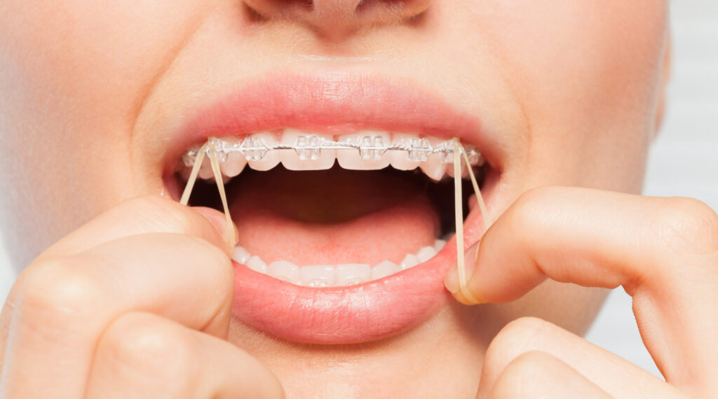 Elastics/rubber bands for braces, woman putting them on